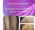 Электроэпиляция